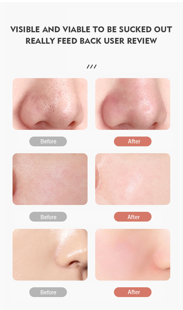 KKS Beauty Products Facial Lift Suction Pimples Removal Deep Cleaning Tool Electric Pore Cleaner Vacuum Blackhead Remover