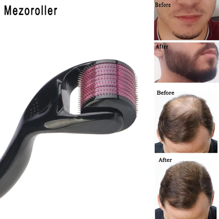 Mezoroller Beard Derma Roller | 540 Needles for Hair Re-Growth &amp; Skin Care 0.2MM