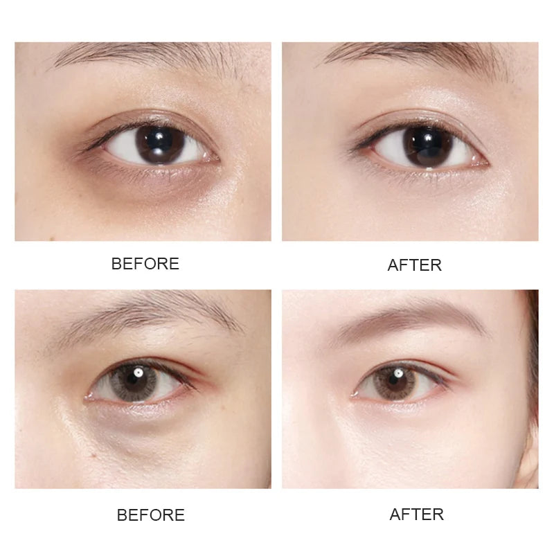 SERSANLOVE Gold Collagen Eye Patches for Dark Circles and Anti-Aging