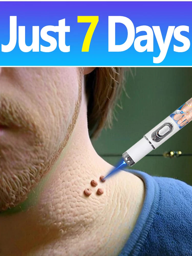 2025 Yükseltme Mavi Lazer Siğil Giderme Aracı Ayaklar için