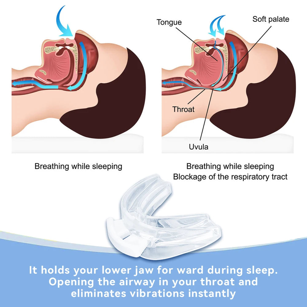 Adjustable Bruxism Mouth Guard &ndash; Improves Sleep Quality