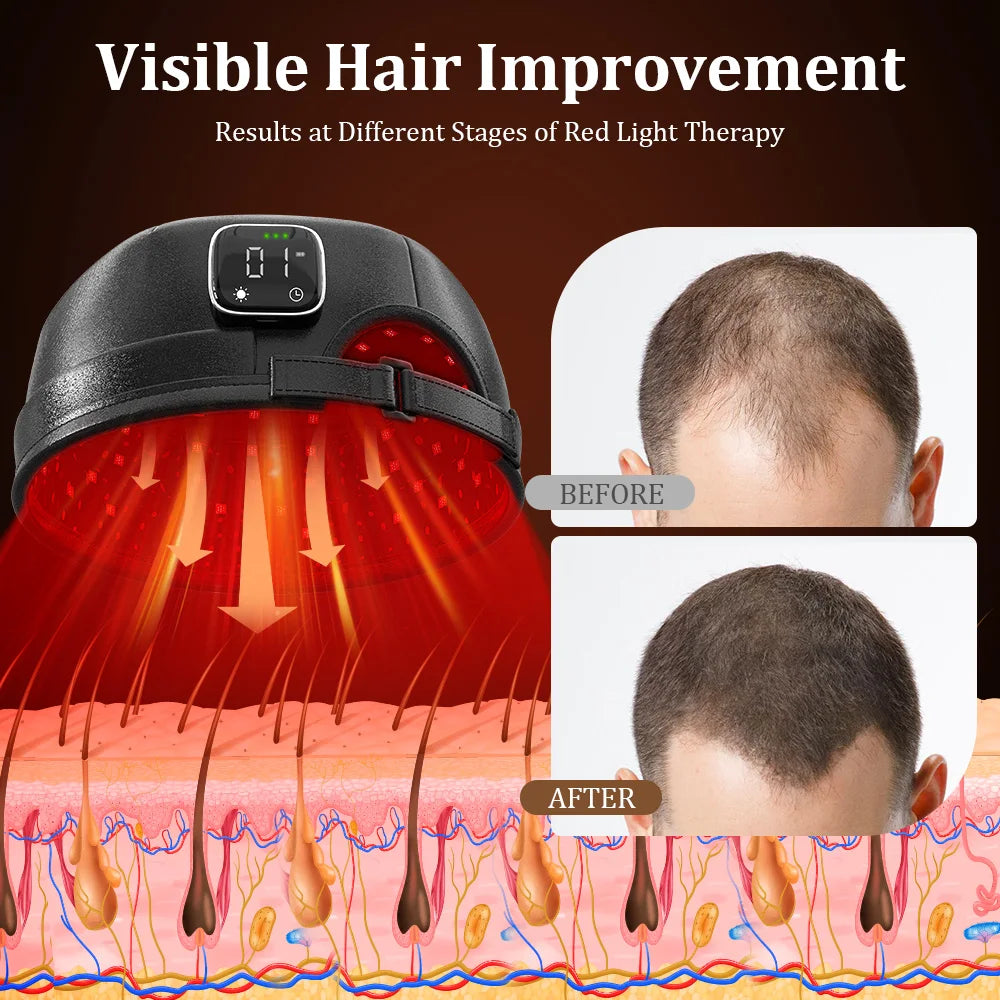 Wireless Hair Growth Laser Cap &ndash; Infrared Light Therapy