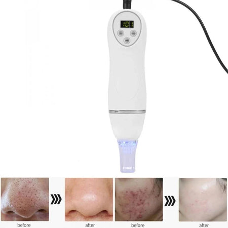 Digital Microdermabrasion Pen &ndash; Pore Refining Acne Treatment