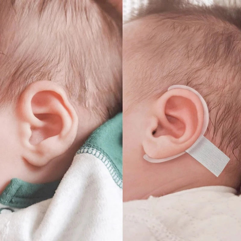 Protruding Ear Support Infant Corrector - Silicone Auricle Correction Patch for Baby