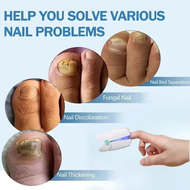 Zařízení na laserovou terapii plísně nehtů pro léčbu onychomykózy