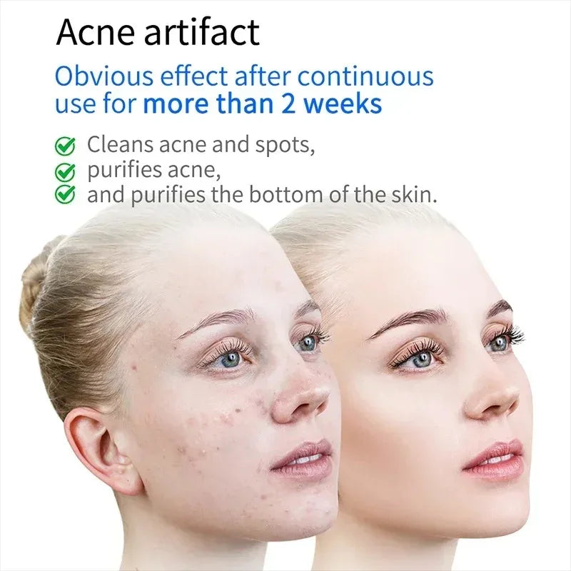 Plasma Facial Massager &ndash; Blue Light Ozone Therapy Device