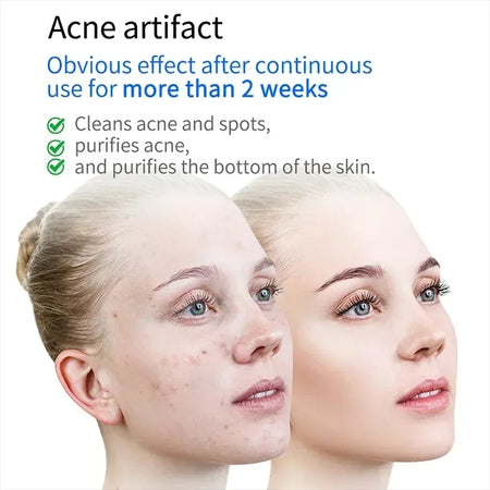 Plasma Facial Massager &ndash; Blue Light Ozone Therapy Device