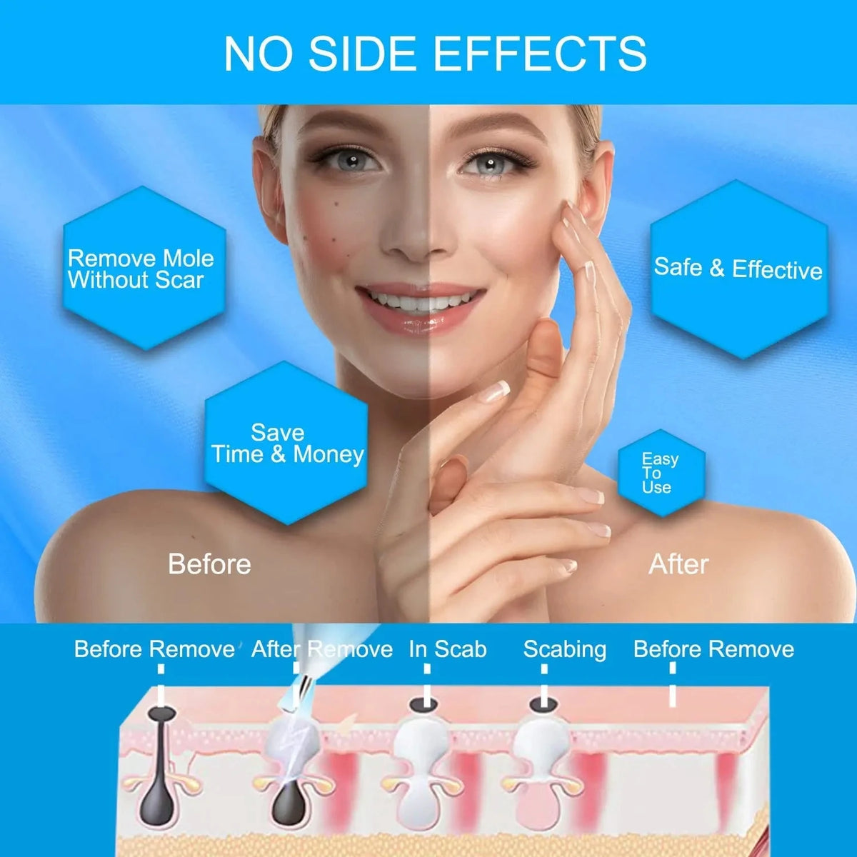 Skin Tag Remover LED Plasma Pen &ndash; Safe Quick Spot Removal