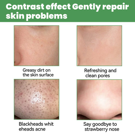 EELHOE Face Cleansing Bubble Mask - Blackhead Remover &amp; Acne Purifying
