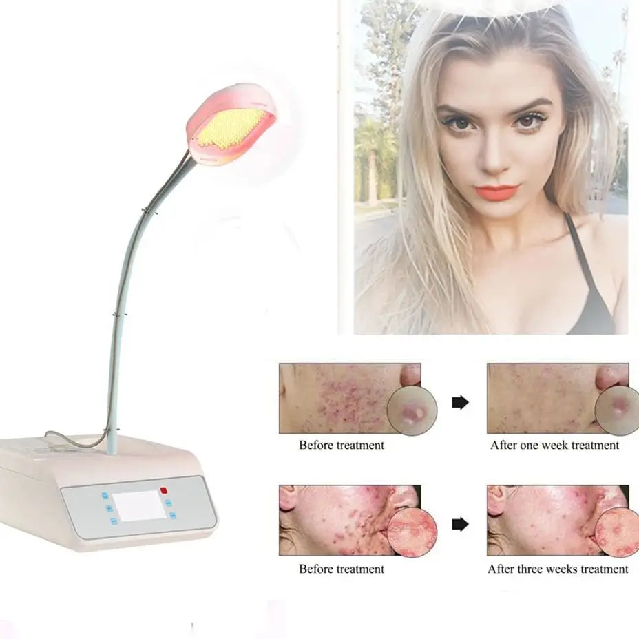 Φορητή Θεραπεία LED με Τροφοδοσία USB για Ακμή και Ομοιόμορφο Χρώμα Δέρματος