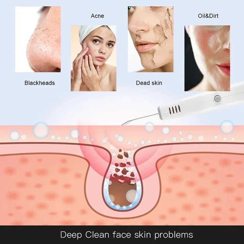 Ultrasonic Facial Scrubber &ndash; Deep Cleansing For Pores