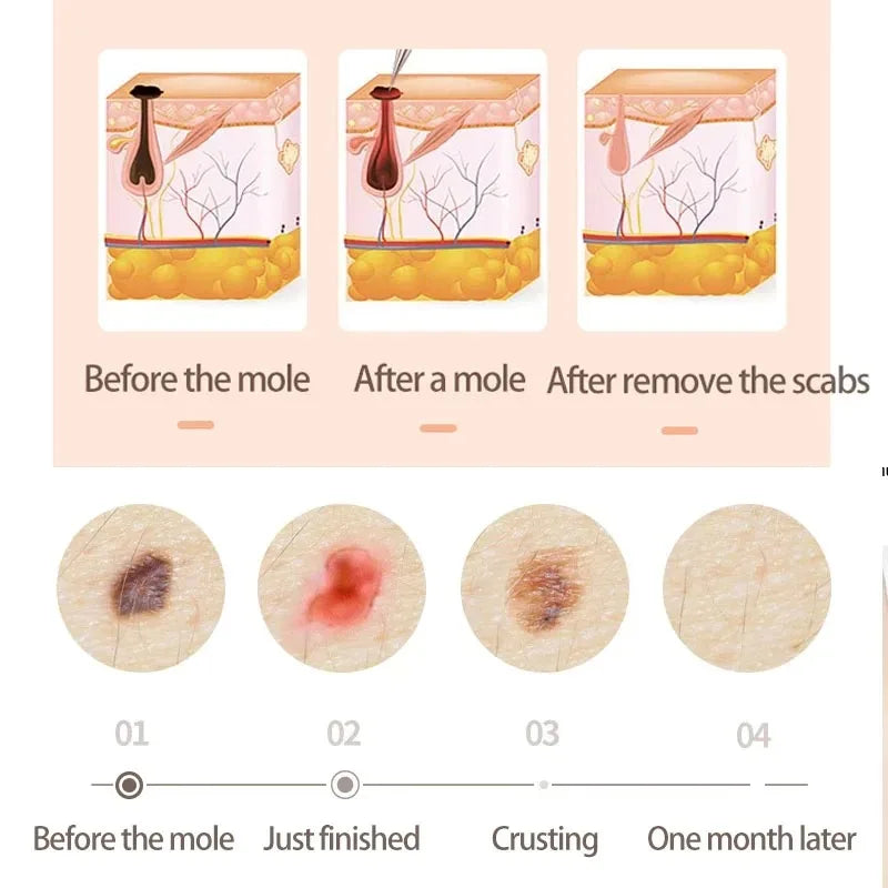 New 30 Gears Professional Tattoo Removal Pen &ndash; Plasma Laser