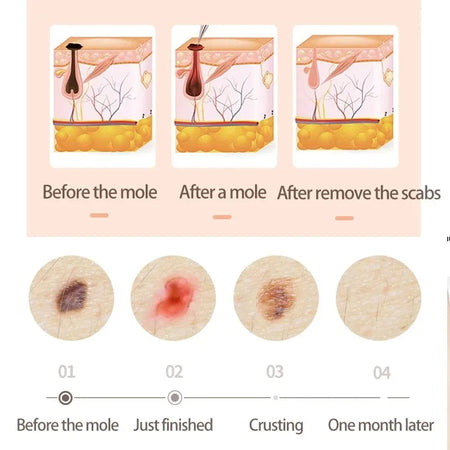 New 30 Gears Professional Tattoo Removal Pen &ndash; Plasma Laser