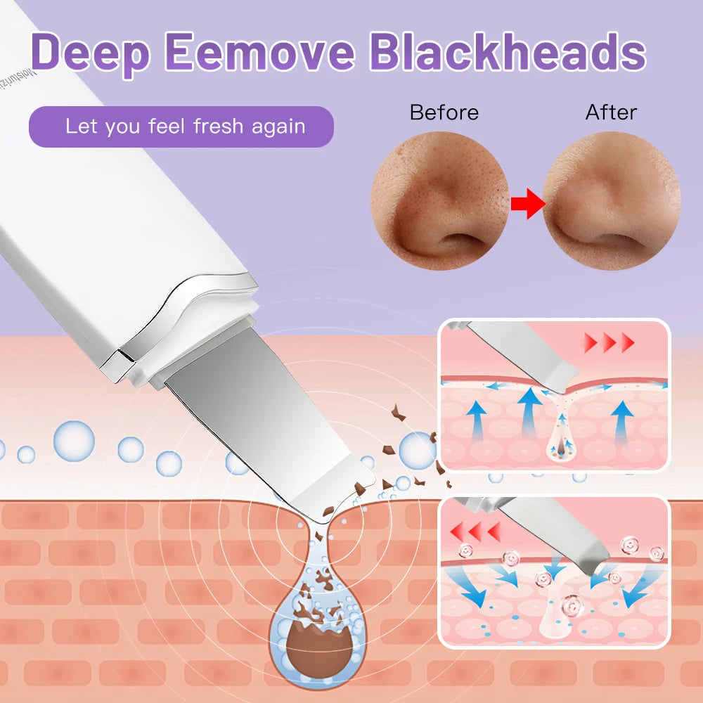 Electric Ultrasonic Skin Scrubber - Blackhead Remover &amp; Facial Lifting Tool