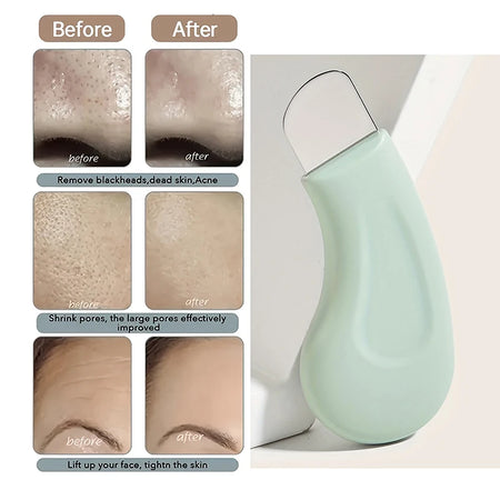 Effective Blackhead Removal Tool for Nasal and Facial Skin Care