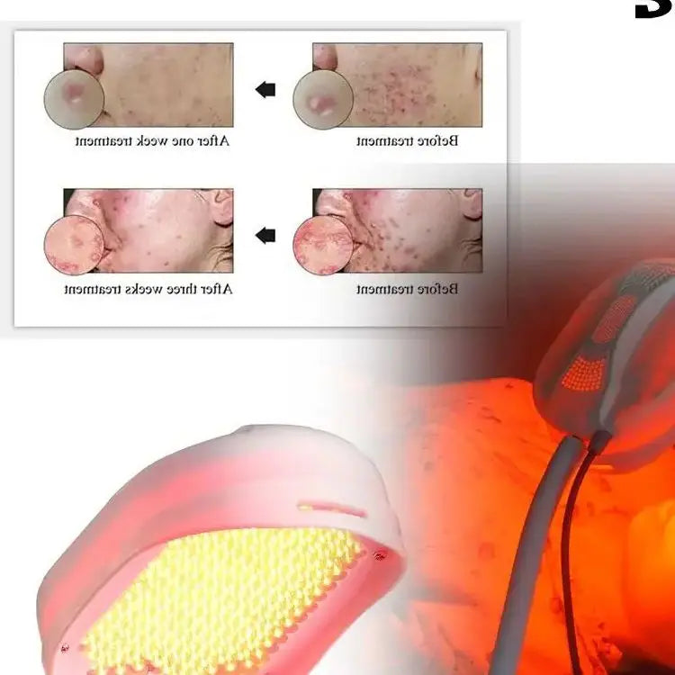 Μάσκα Προσώπου με Κόκκινο και Μπλε LED Φωτονικής Θεραπείας για Ακμή και Αναζωογόνηση