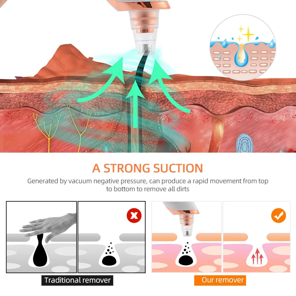 ForeverLily Blackhead Remover &ndash; Effective Facial Cleansing