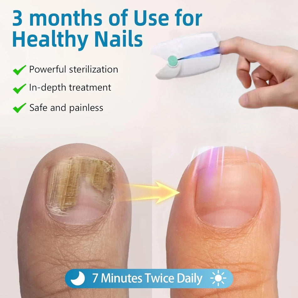Zařízení na nehtovou houbu Laserová terapie bez bolesti pro nehty na nohou přenosné
