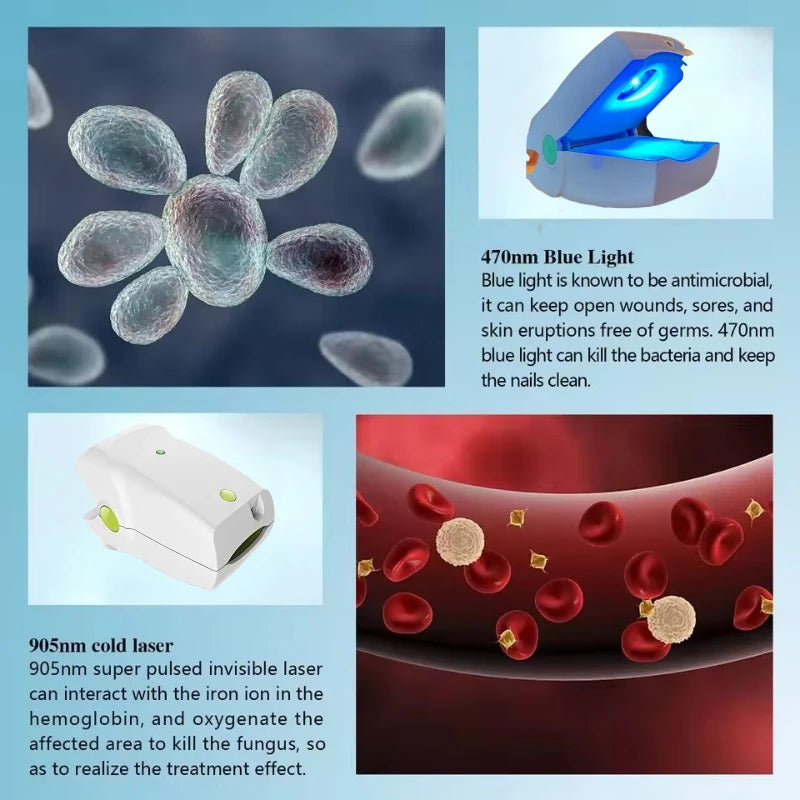 Laserová terapie nehtů 905nm nové generace pro plísňové infekce