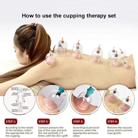 Cupping Therapy Set &ndash; Effective Cellulite Relief and Back Pain Therapy