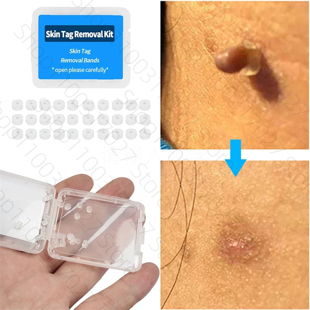 30pcs Skin Tag Remover Rubber Rings - Non-Toxic &amp; Painless Wart Removal