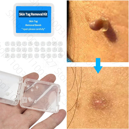 30pcs Skin Tag Remover Rubber Rings - Non-Toxic &amp; Painless Wart Removal