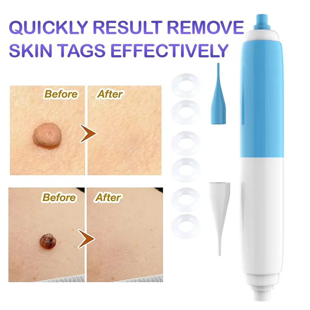 2-In-1 Skin Tag Wart Removal Kit - Painless Auto Removal