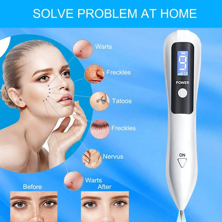 Skin Tag Remover LED Plasma Pen &ndash; Safe Quick Spot Removal