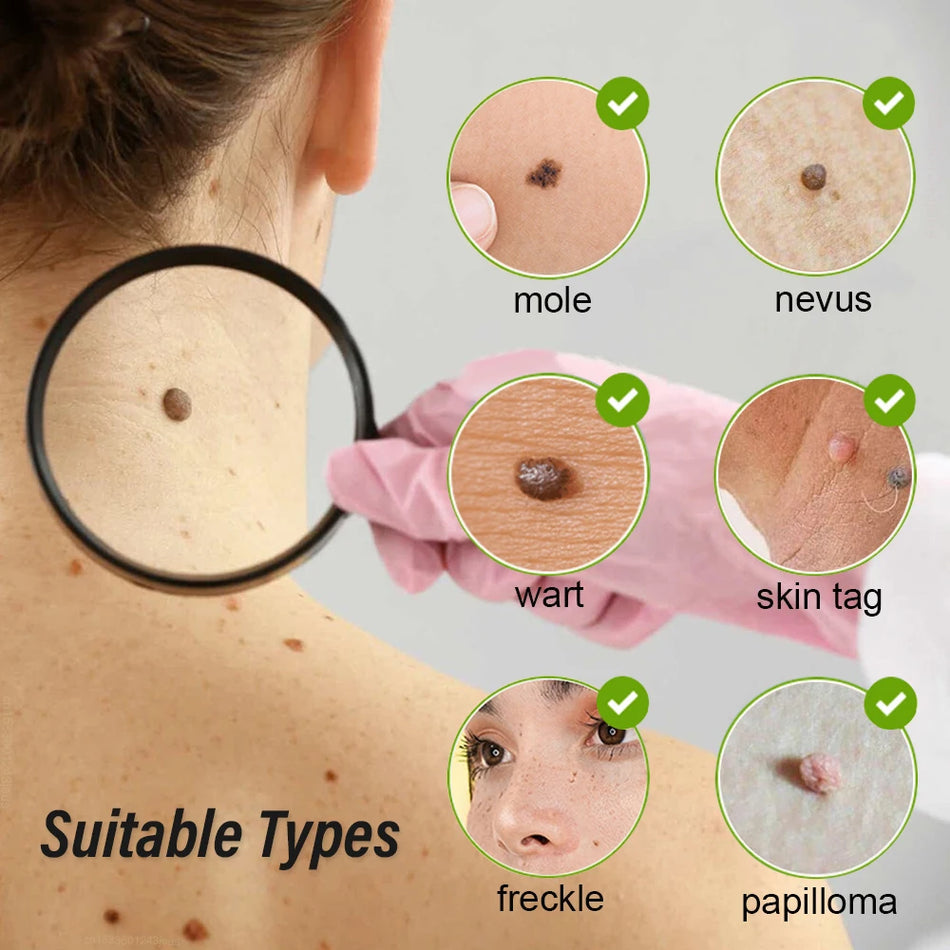 Laser Plasma Pen Wart Remover for Dark Spots, Freckles, Moles, Papillomas
