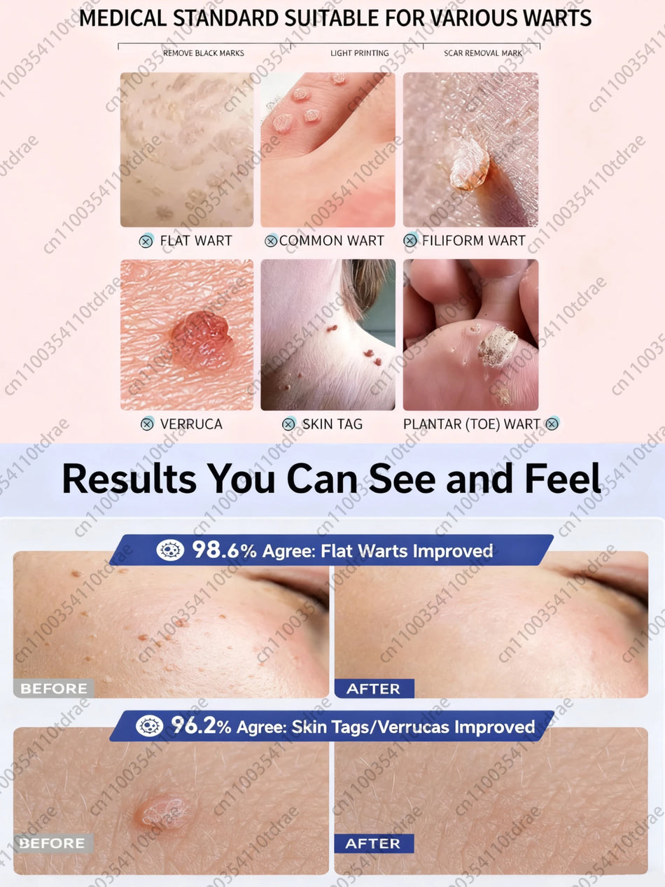 Kotikäyttöinen syylänpoistolaastari jaloille, hellävarainen, nopea 7 päivän tulokset