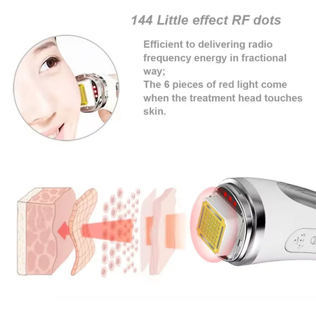 Radio Frequency Facial Lifting Machine &ndash; Wrinkle Reduction