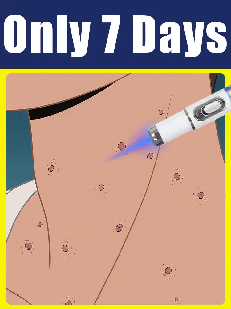 Синя светлина брадавица писалка инструмент за грижа за краката пластмасов неелектрически