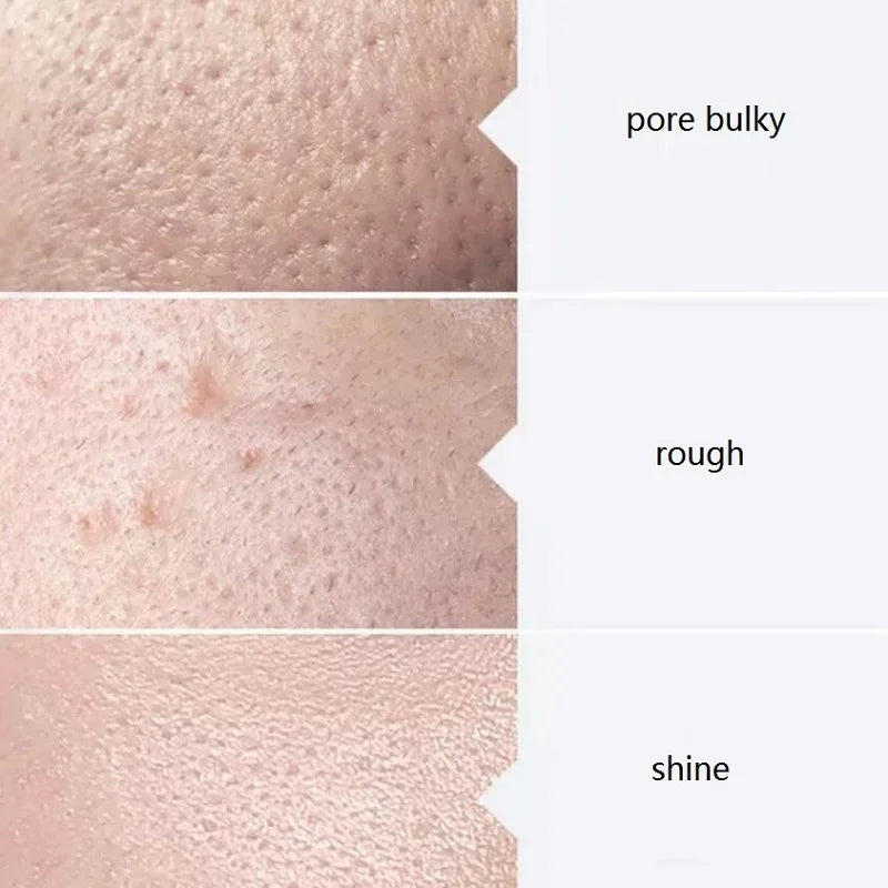 Aqua Peel Solution AS1 SA2 AO3 - Deep Cleansing For Pores