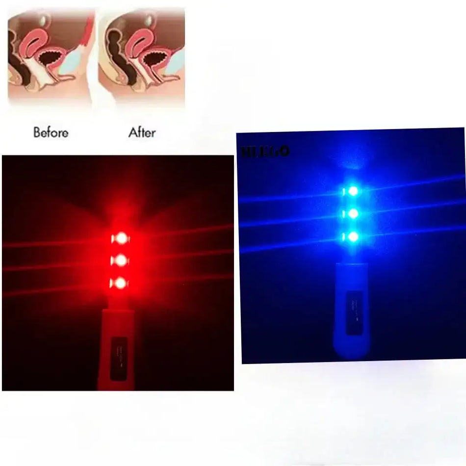 Gynecological LED Red Blue Therapy Massage Inflammation