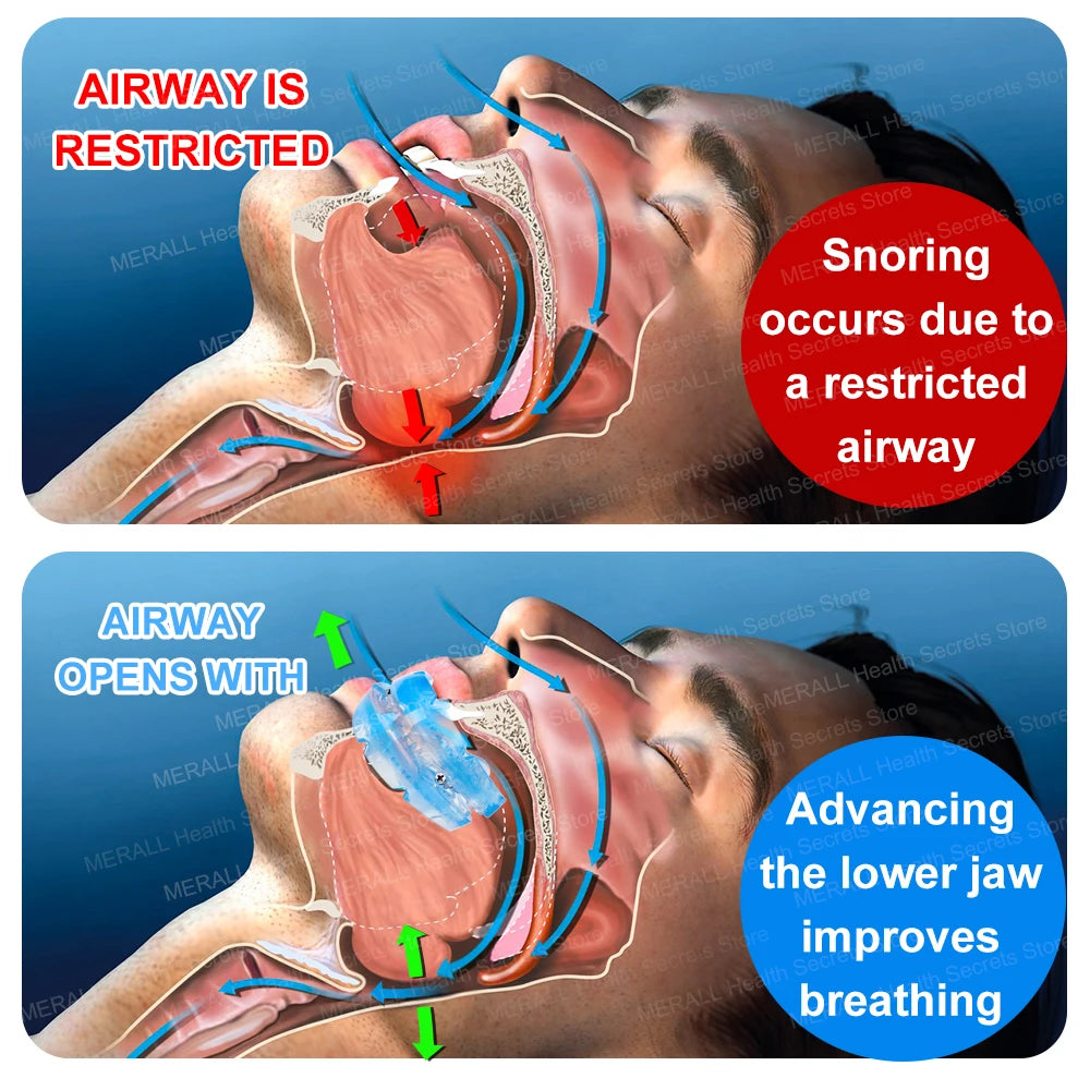 MERALL Anti-Snoring Mouthpiece &ndash; Bruxism Guard for Sleep