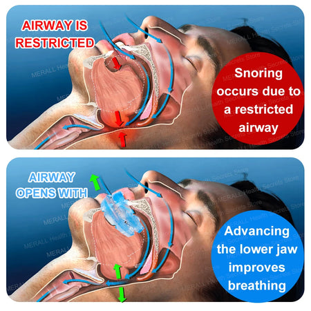 MERALL Anti-Snoring Mouthpiece &ndash; Bruxism Guard for Sleep