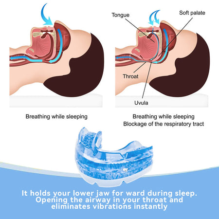 Anti Snore Bruxism Mouth Guard | Stop Snoring &amp; Sleep Aid