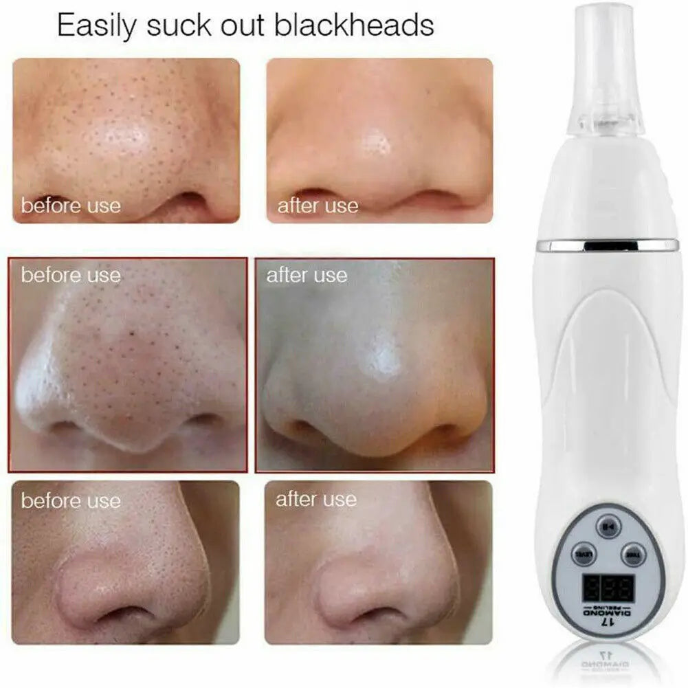 Monai Microdermabrasion Pen - Deep Cleansing Tool Pro