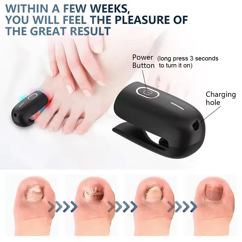 KTS Nail Fungus Laser Device &ndash; Fast Toenail Fungus Treatment