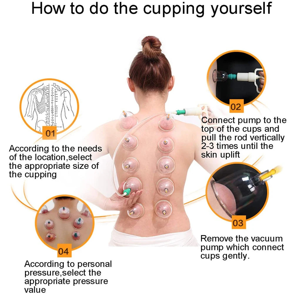 Cupping Therapy Set &ndash; Effective Cellulite Relief and Back Pain Therapy