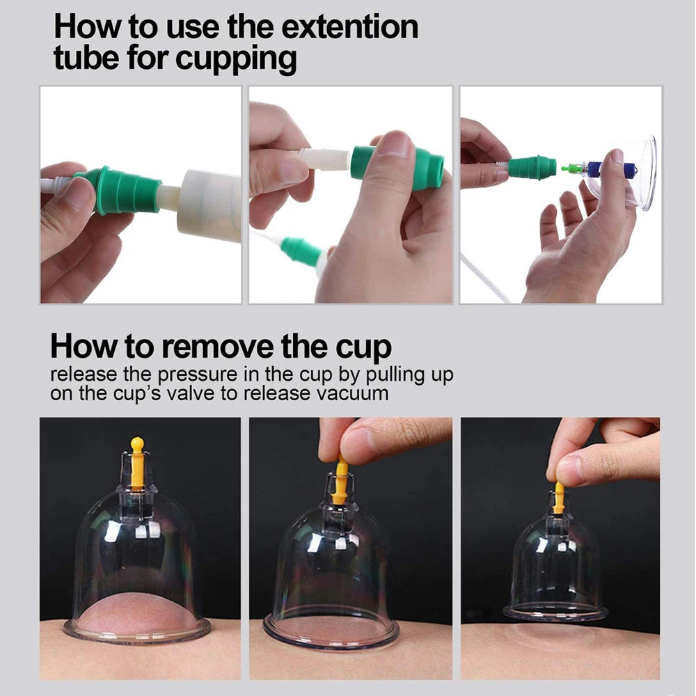 Cupping Therapy Set &ndash; Effective Cellulite Relief and Back Pain Therapy