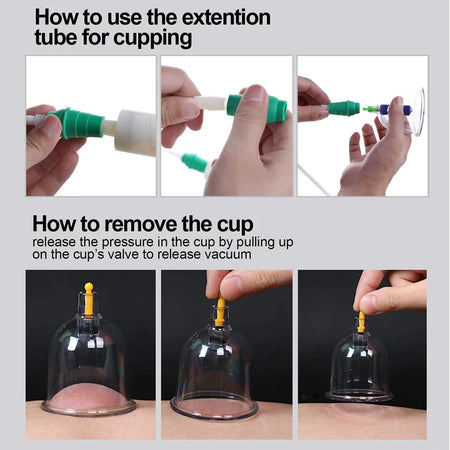 Cupping Therapy Set &ndash; Effective Cellulite Relief and Back Pain Therapy