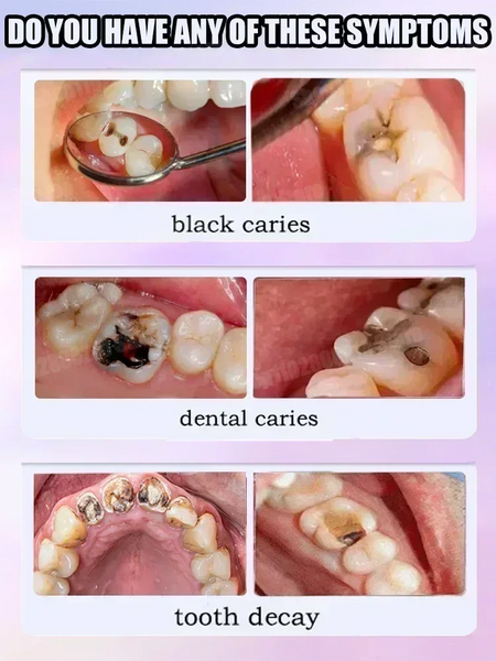 Teeth Cleaning Toothpaste &ndash; Stain Removal and Decay Repair