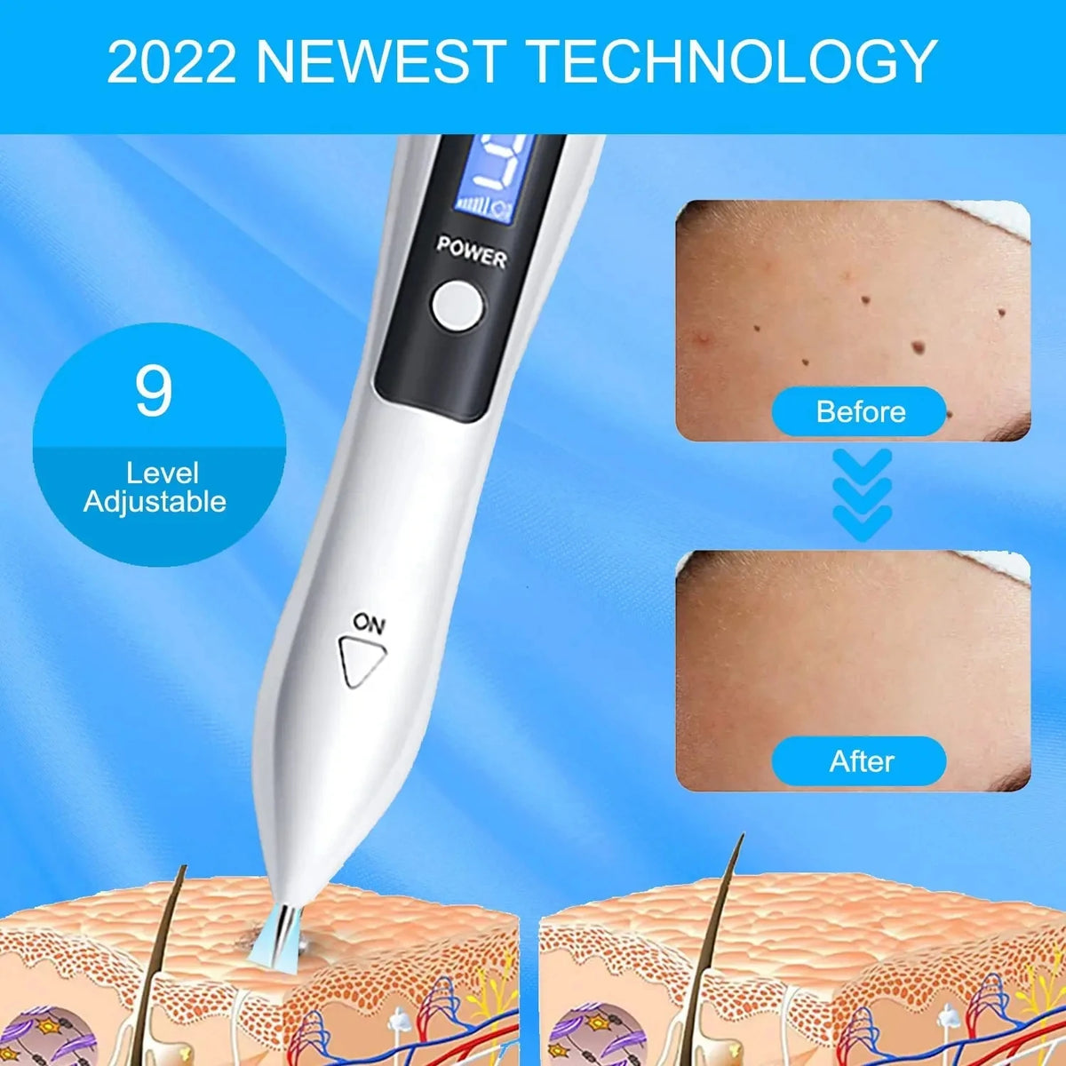 Skin Tag Remover LED Plasma Pen &ndash; Safe Quick Spot Removal