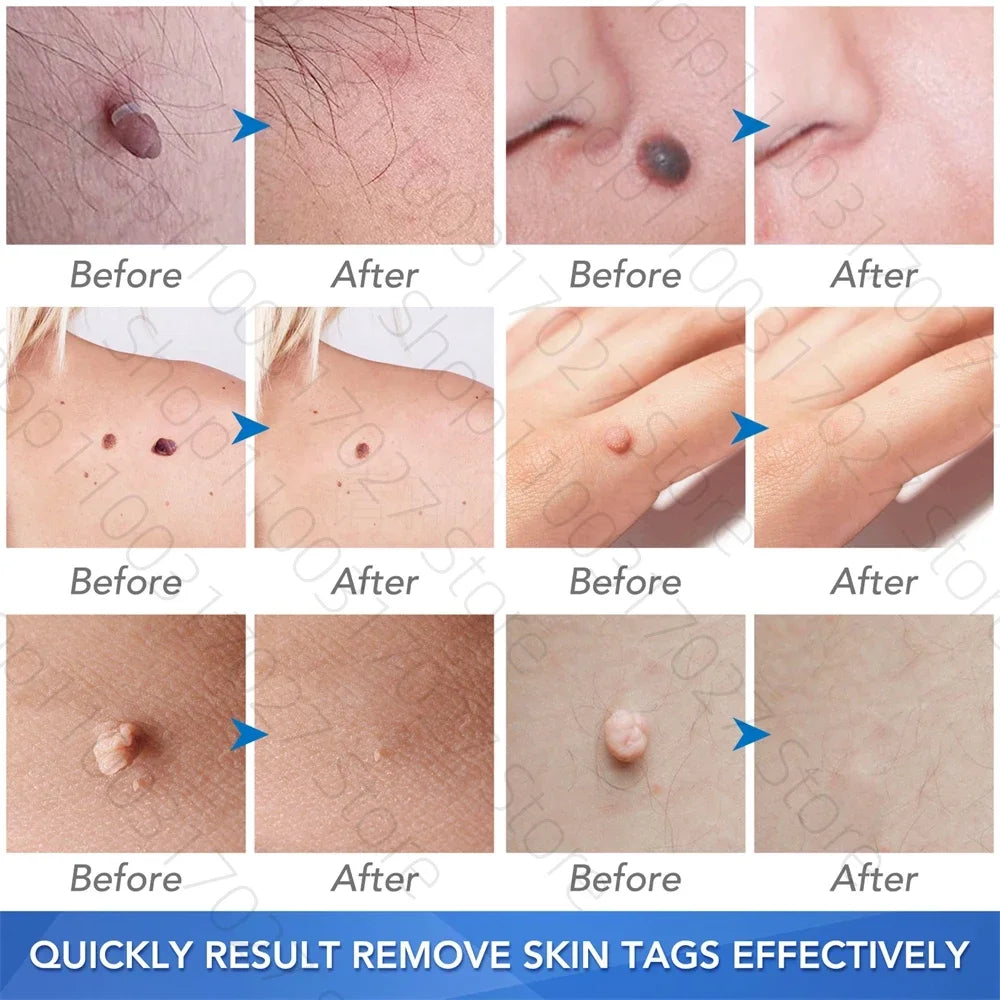 30pcs Skin Tag Remover Rubber Rings - Non-Toxic &amp; Painless Wart Removal