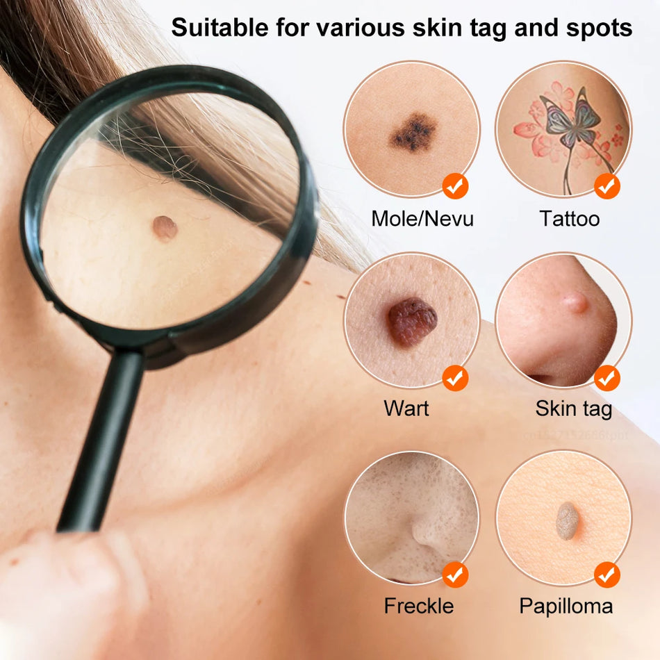 Laser Plasma Pen for Wart and Dark Spot Removal, Skin Tag and Freckle Eliminator