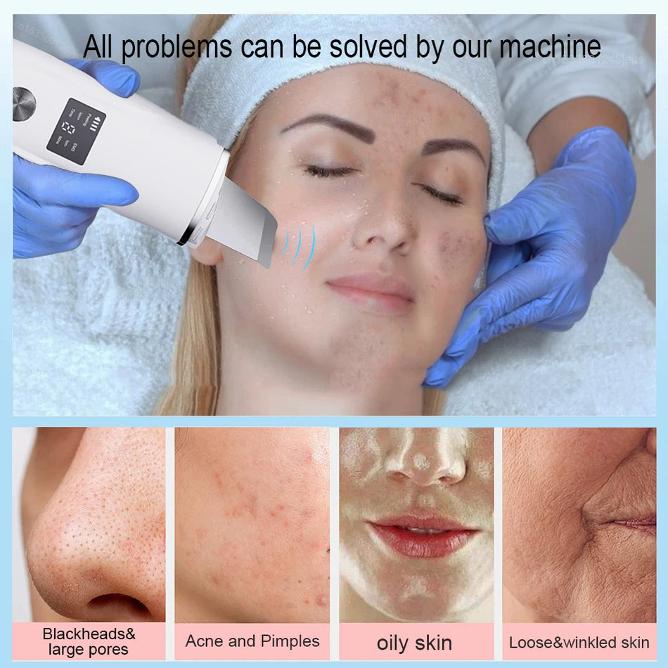 Ultrasonic Skin Scrubber for Blackheads and Pore Cleaning, Facial Tool