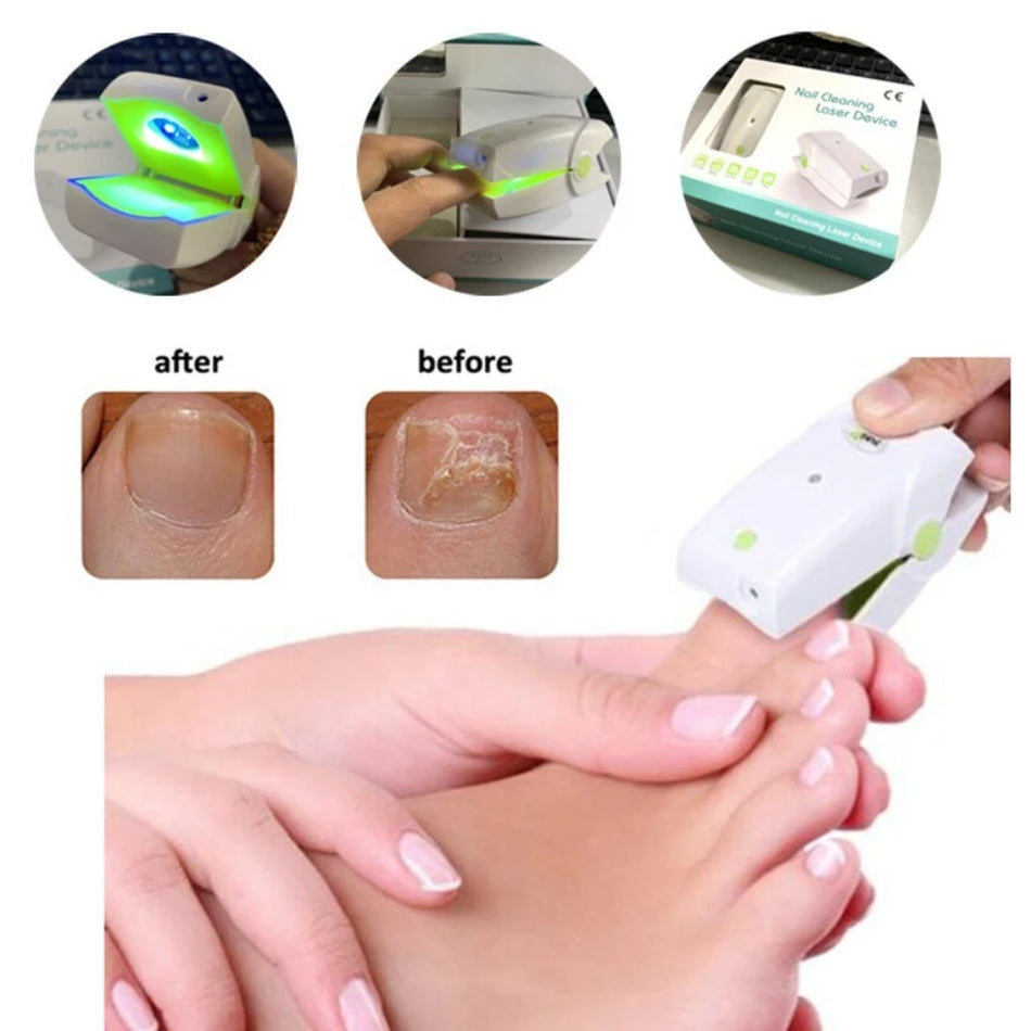 Zařízení na nehtovou houbu Laserová terapie bez bolesti pro nehty na nohou přenosné