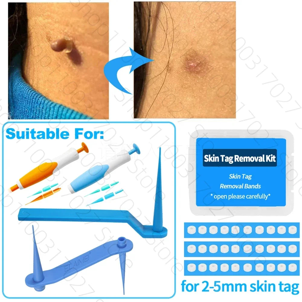 30pcs Skin Tag Remover Rubber Rings - Non-Toxic &amp; Painless Wart Removal