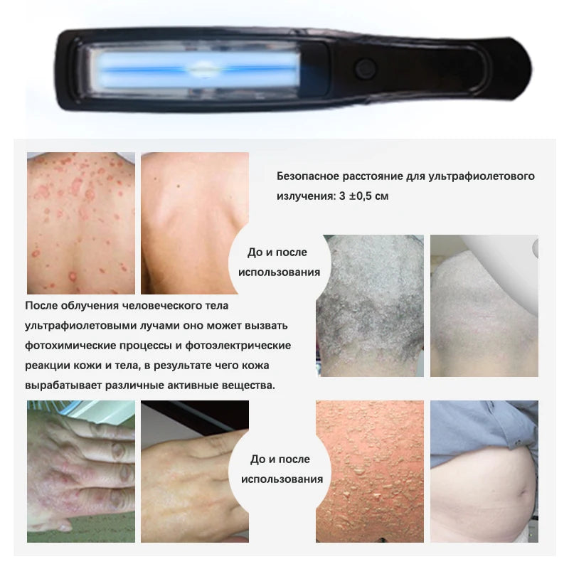 UVB Vitiligo Therapy Light UV311nm Lamp &ndash; Clinical UV Lamp